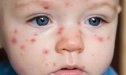 Azərbaycanda suçiçəyi xəstəliyi&nbsp;artır:&nbsp;uşaqlar üçün risklər nələrdir?