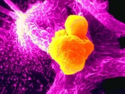 Xərçəngin müalicəsində inqilabi - YENİLİK