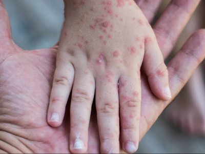  Məktəblərdə qızılcaya qarşı hansı tədbirlər görülür? - Rəsmi AÇIQLAMA   