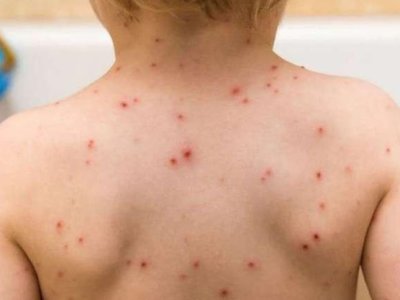 Qızılcaya görə məktəblərdə şagirdlərin temperaturu ölçülür