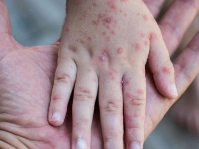 Səhiyyə Nazirliyindən qızılca ilə bağlı ÇAĞIRIŞ