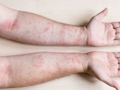 Qızılcaya yoluxma yenidən ARTIR