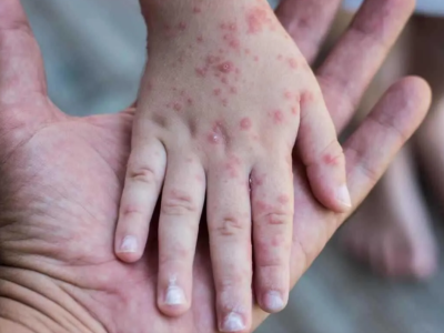 Övladınızı qızılca bəlasından bu şəkildə QORUYUN