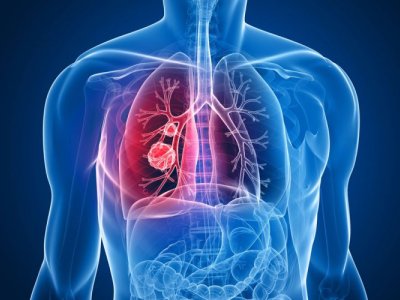 Alimlər xərçəngə qarşı ilk peyvənd hazırladılar