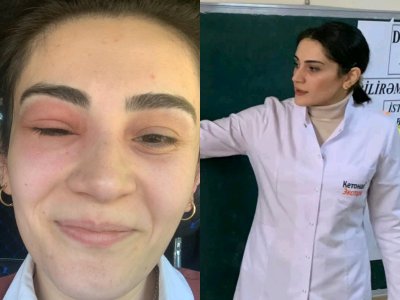 Gözünü arı sancan kimya müəllimi: “Tək gözlə 55 bal topladım”