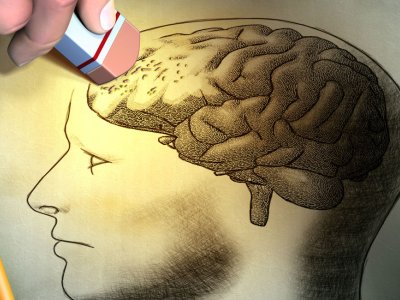 Alzheimerin qarşısını alan yeni molekulyar üsul kəşf edildi