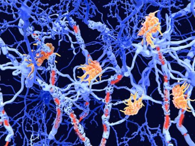 MS xəstəliyində inqilab: Alimlər iki yeni alt-tip aşkar edib