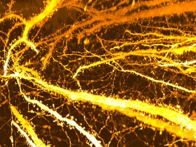 Alimlər xroniki yaraların müalicəsində yeni üsul tapıblar