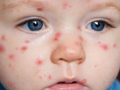 Azərbaycanda suçiçəyi xəstəliyi&nbsp;artır:&nbsp;uşaqlar üçün risklər nələrdir?
