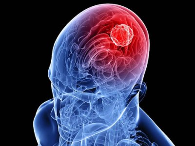 Yeni kəşf: Beyin xərçəngi şiş yaranmazdan əvvəl başlayır