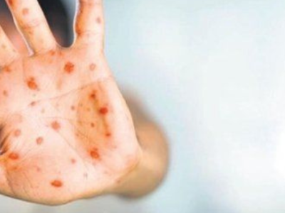 Meymunçiçəyinin əsas əlamətləri&nbsp;açıqlandı