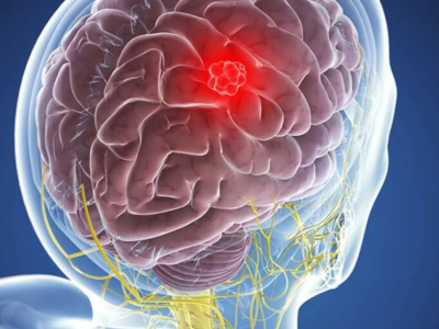 Beyin şişlərinə qarşı inqilabi kəşf