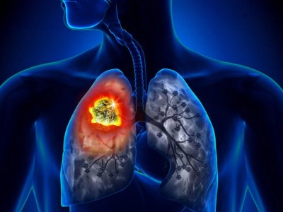 Alimlər ağciyər xərçənginin zəif tərəfini tapıb