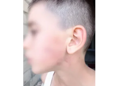 Məktəbdə uşağı şillə ilə vuran müəllimlə bağlı RƏSMİ AÇIQLAMA