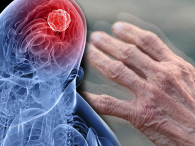 Parkinson xəstəliyinin müalicəsində mühüm kəşf