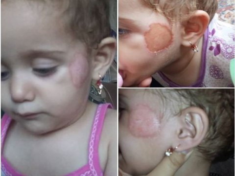 Gəncədə uşaq bağçasında iki nəfər işdən çıxarıldı, müdir töhmət aldı - Körpənin üzü yandığına görə