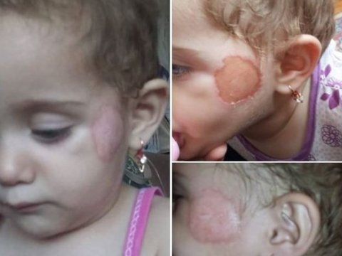 Bağçada üzü yanan körpə ilə bağlı qəribə həkim RƏYİ