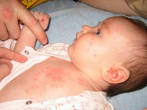 Uşaqlar arasında dəri xəstəliklərinə yoluxma artıb