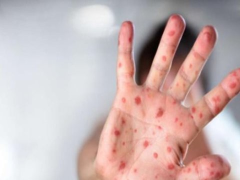 Zaqatalada qızılca xəstəliyi yayılıb