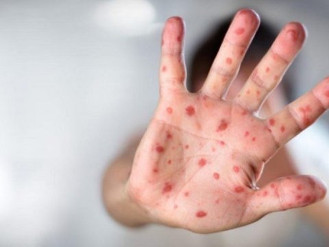 Region məktəblərində kütləvi qızılca yayılıb -  Vəziyyət necədir?