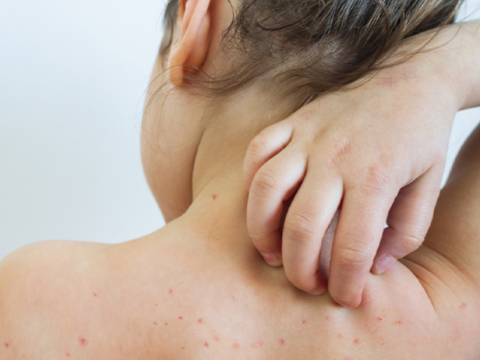 Pediatrdan SOS : “Qızılcanın fəsadları illərlə bədəndə qalır”  