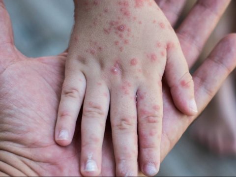  Məktəblərdə qızılcaya qarşı hansı tədbirlər görülür? - Rəsmi AÇIQLAMA   