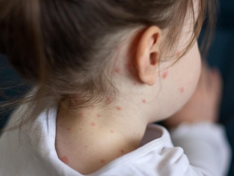 Qızılca BƏLASI: “Məktəblərdə qapanmalara ehtiyac yoxdur”