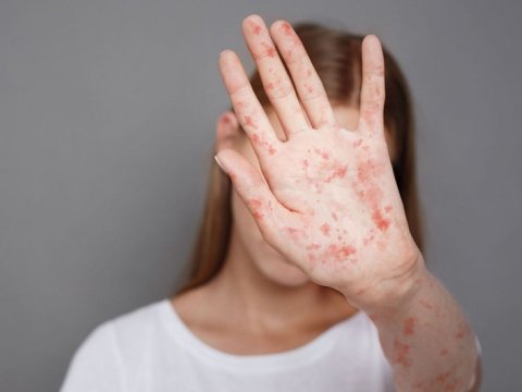 Nazirlikdən qızılca ilə bağlı ÇAĞIRIŞ: 10 yaşa qədər uşaqlar...