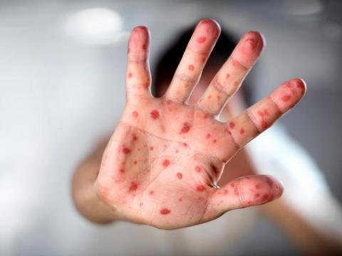 SN qızılca peyvəndi ilə bağlı valideynlərə xəbərdarlıq edib