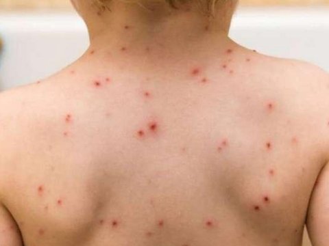 1-ci sinif şagirdi qızılcadan öldü - FOTO