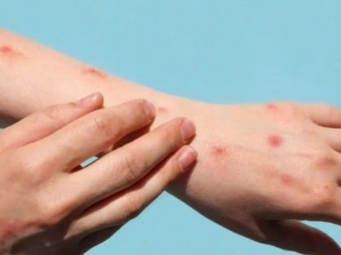 7-ci sinif şagirdi qızılcadan VƏFAT ETDİ