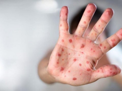 Qazax-Tovuz RTİ: “Şagirdlər arasında qızılcaya yoluxma halı nəzarətdədir”