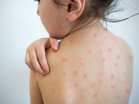 Azərbaycanda qızılca xəstəliyi tək-tək qeydə alınır -&nbsp;RƏSMİ