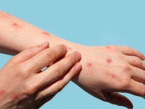 Qızılcaya yoluxma faktları kəskin artıb