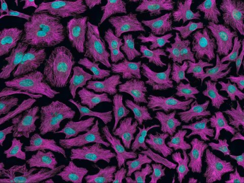 Xərçəngli hüceyrələrin sağlam vəziyyətə qaytarılması üçün texnologiya hazırlandı