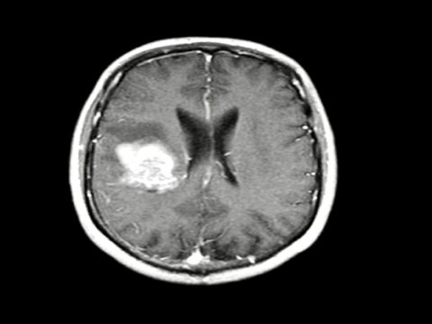 ALİMLƏR: Təzyiq dərmanı beyin şişinə çarə ola bilər 