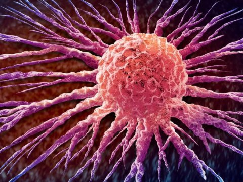 Süd vəzi xərçənginin yayılması irsidir -&nbsp;TƏDQİQAT