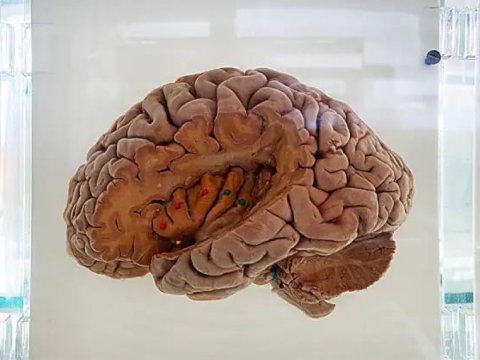 İnfarkt tam sağala bilər? Alimlərdən araşdırma   