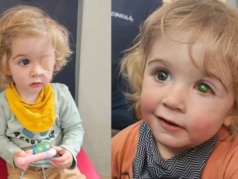 İngiltərədə iki yaşlı uşaq bir öpüşə görə gözünü itirdi