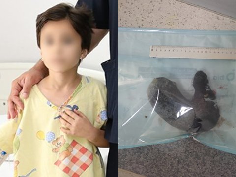 Ürəkbulanmadan şikayətlənirdi, mədəsindən saç çıxarıldı - Foto