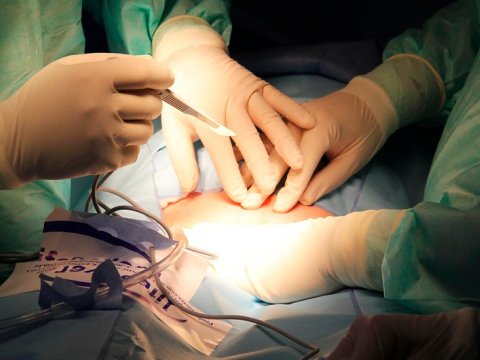 Alimlər ilk dəfə donuzun ağciyərini insan bədəninə köçürüblər