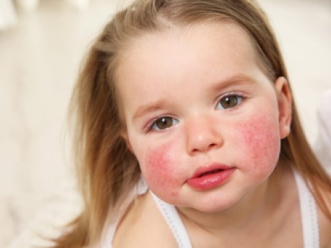 Ana südü azdırsa, allergiya riski artır - pediatrdan XƏBƏRDARLIQ