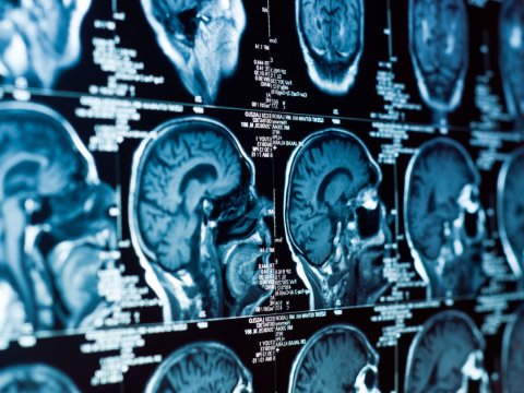 Altsheymer xəstəliyinin müalicəsində qeyri-adi üsul tapılıb