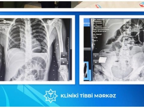 Yeniyetmənin bağırsağından taxta çıxarılıb