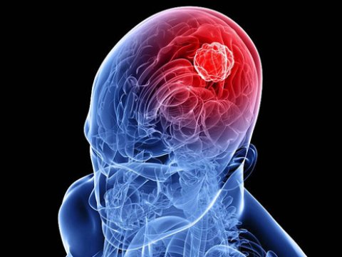 Yeni kəşf: Beyin xərçəngi şiş yaranmazdan əvvəl başlayır