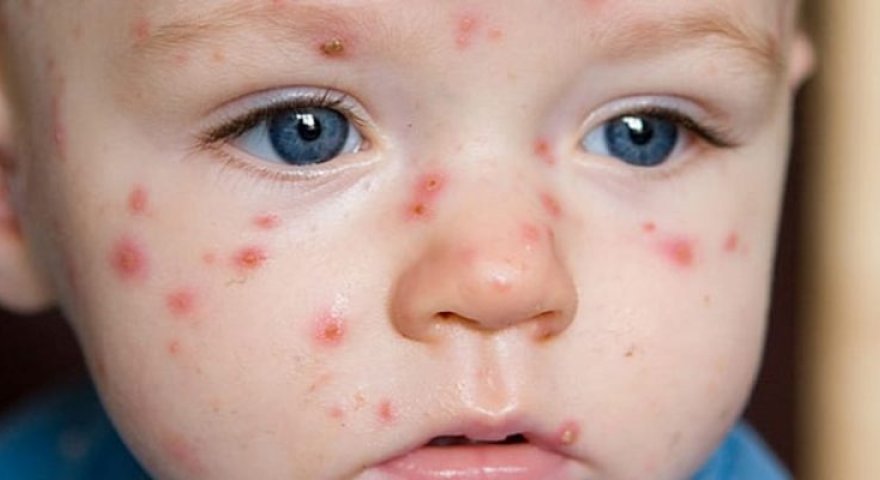 Azərbaycanda suçiçəyi xəstəliyi&nbsp;artır:&nbsp;uşaqlar üçün risklər nələrdir?