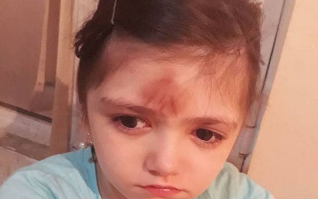 “Xətkeş qalxıb uşağın alnına dəyib” – Döyülən  şagirdlə bağlı rəsmi açıqlama