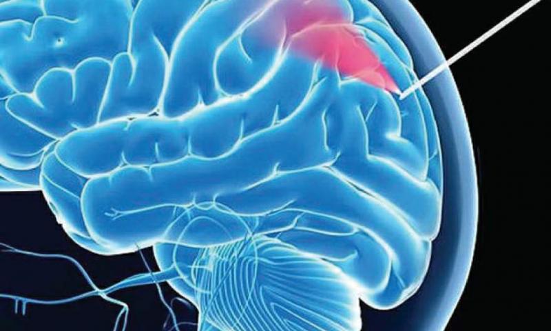 Beyin biopsiyası üçün kameralı “ağıllı” iynə yaradıldı