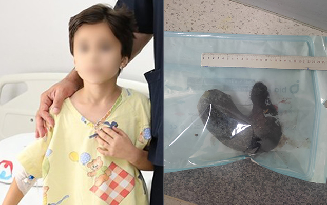 Ürəkbulanmadan şikayətlənirdi, mədəsindən saç çıxarıldı - Foto