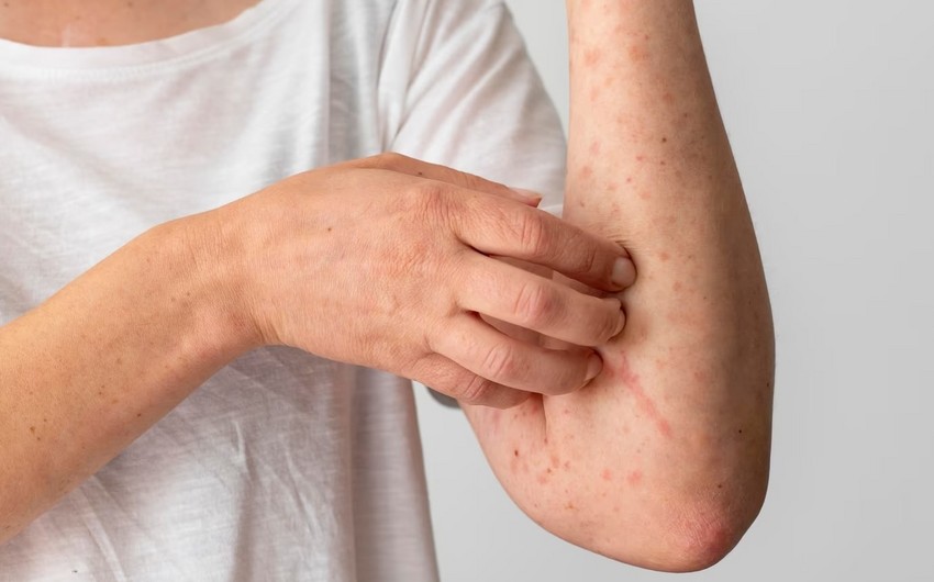 Alimlər insanı öldürən infeksiyanı dayandıran anticisim yaradıblar